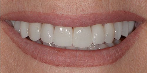 Old Ugly Dentistry - Rebecca - After
